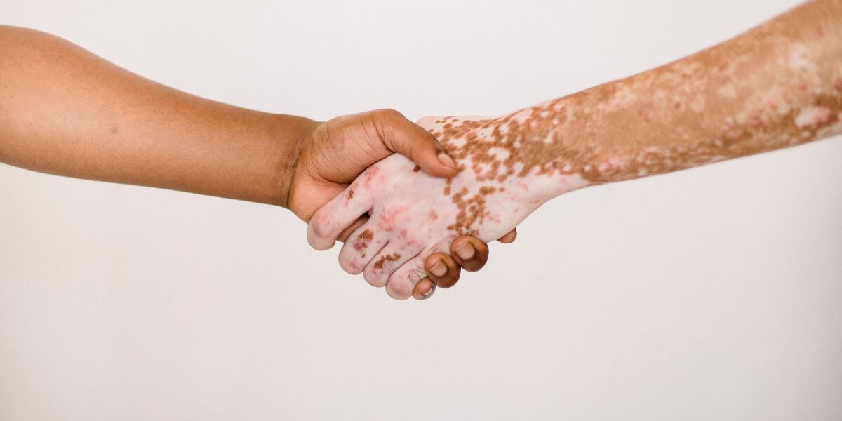 Psoriasis and Mental Health: The Connection You Need to Know