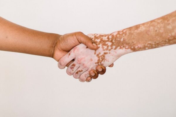 Psoriasis and Mental Health: The Connection You Need to Know