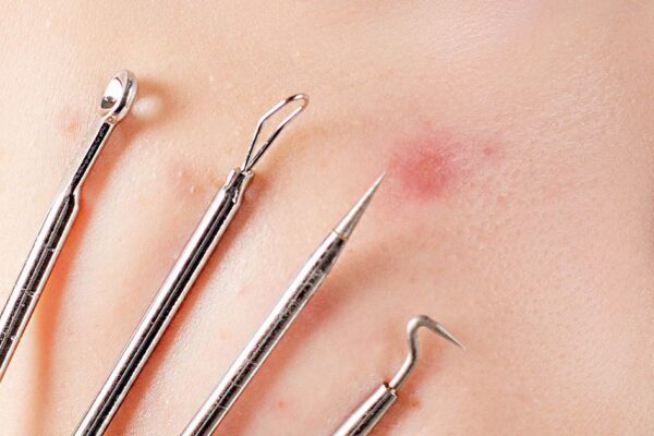Why Adults Get Acne, and What You Can Do About It