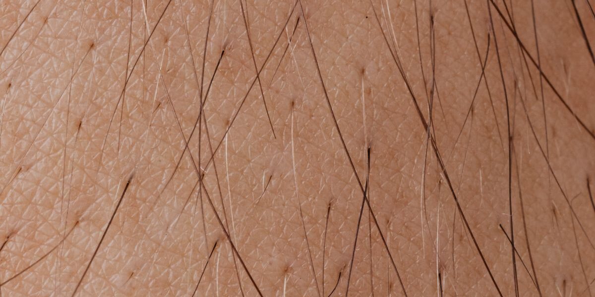 Living With Moderate-to-Severe Atopic Dermatitis: A Practical Guide