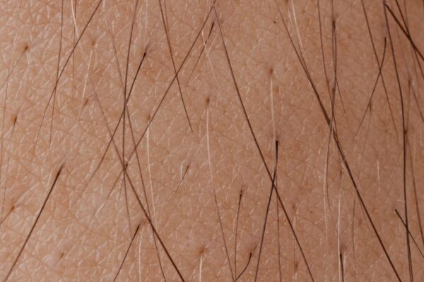 Eczema in Children: When to Consider a Clinical Trial