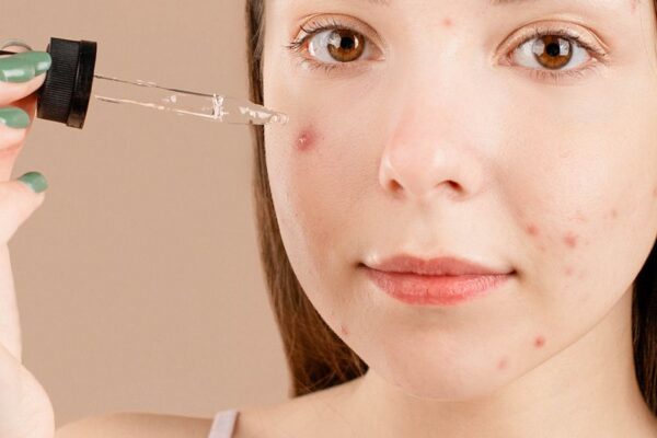 Acne Skincare: What Helps and What Makes It Worse
