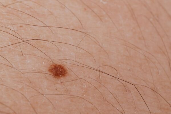 What Is NEMLUVIO? Everything Patients Should Know