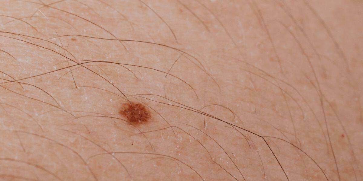 What Is NEMLUVIO? Everything Patients Should Know