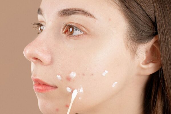 What Is Cutibacterium Acnes? The Role of Bacteria in Acne