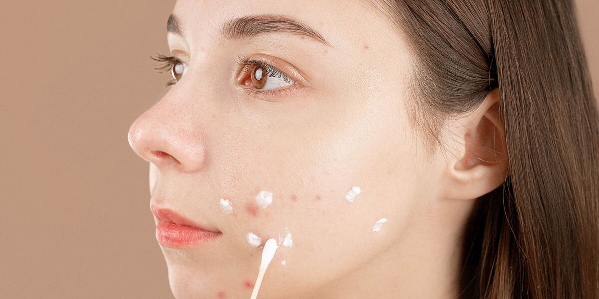 Hormonal Acne: Causes, Patterns, and Treatment Options