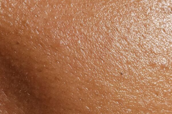 Skin Care Tips for Living in South Florida With Eczema