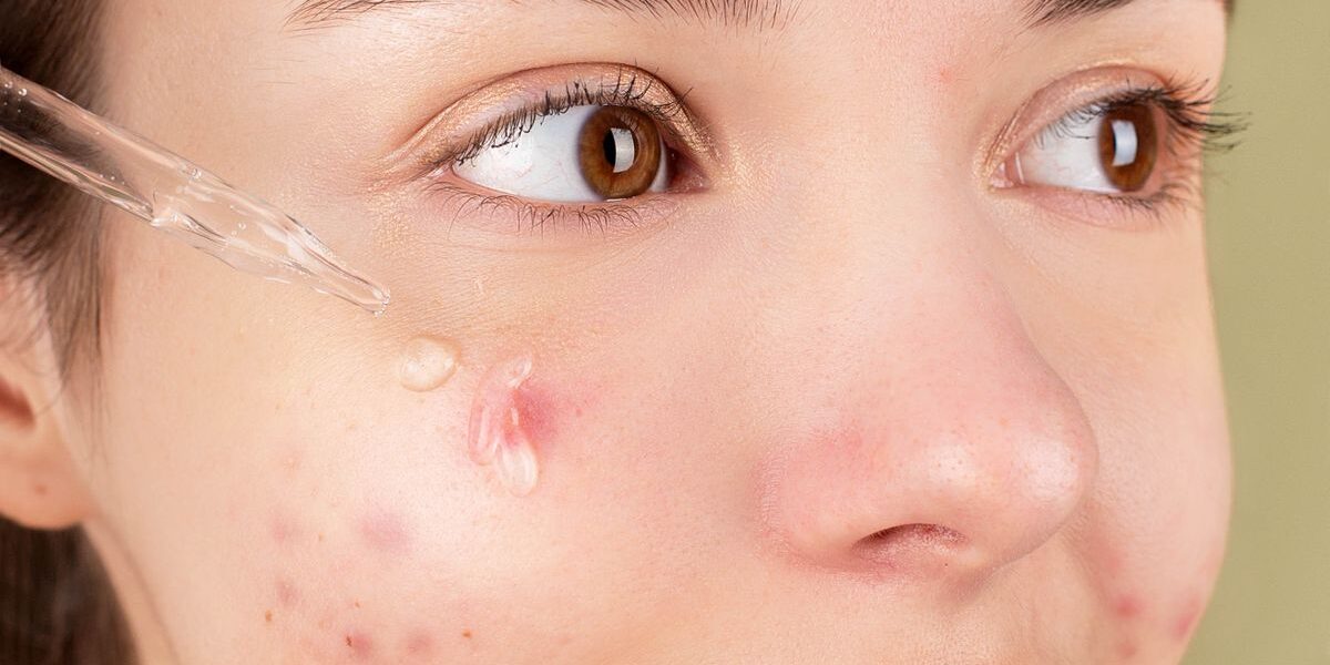 What Is the IGA Score? How Physicians Assess Acne Severity