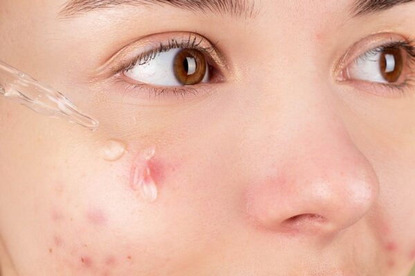 What Is the IGA Score? How Physicians Assess Acne Severity