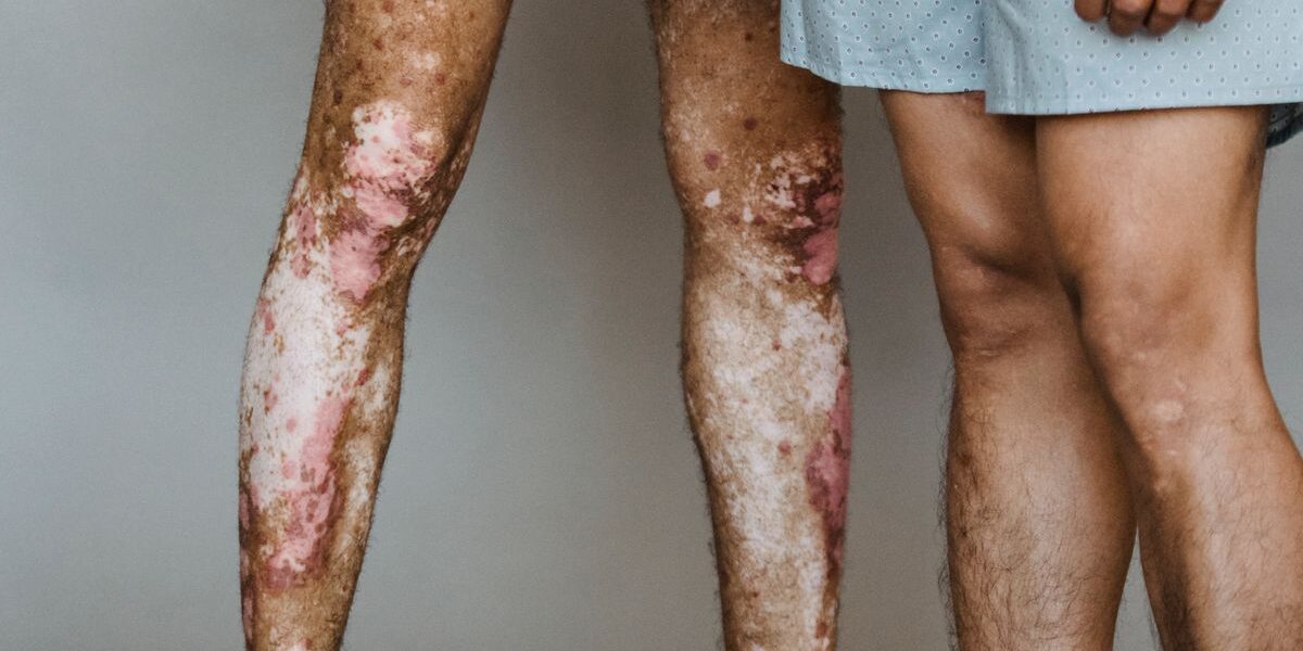 What Is Plaque Psoriasis? Symptoms, Causes, and Current Treatments