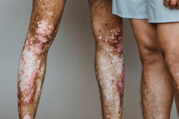 What Triggers Psoriasis Flares, and How to Reduce Them