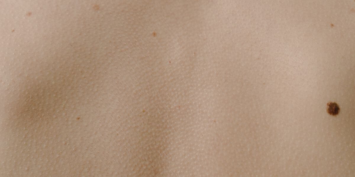 Biologic Treatments for Atopic Dermatitis: The Latest Advances