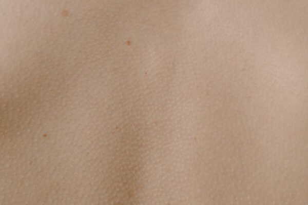 Biologic Treatments for Atopic Dermatitis: The Latest Advances