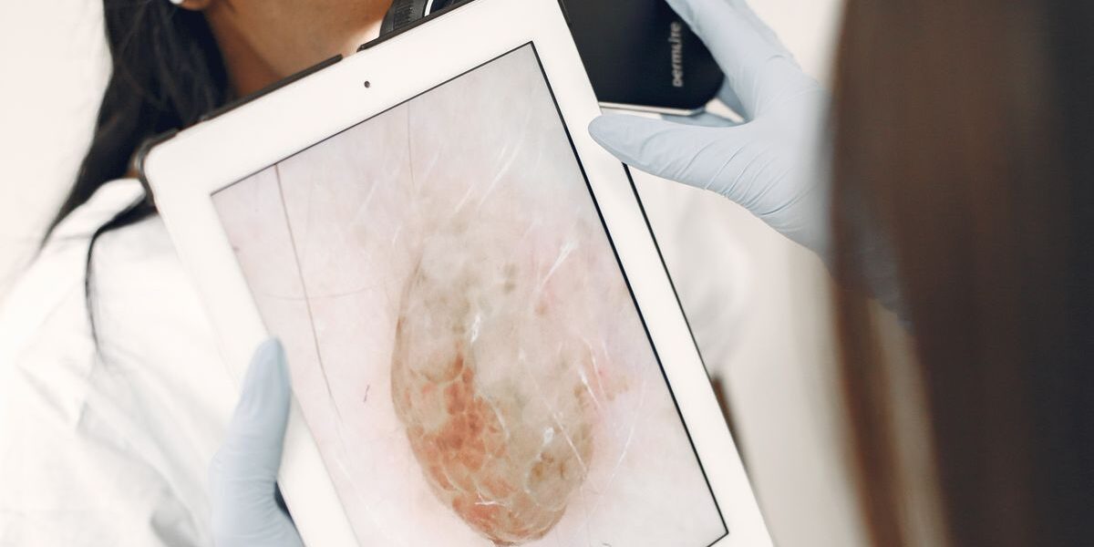 Cystic Acne: What It Is, Why It Scars, and How to Treat It